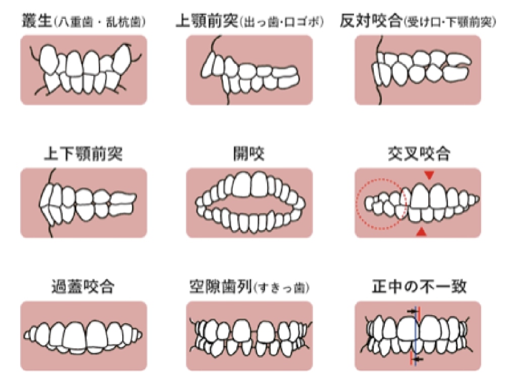 悪い歯並び(不正咬合)の種類